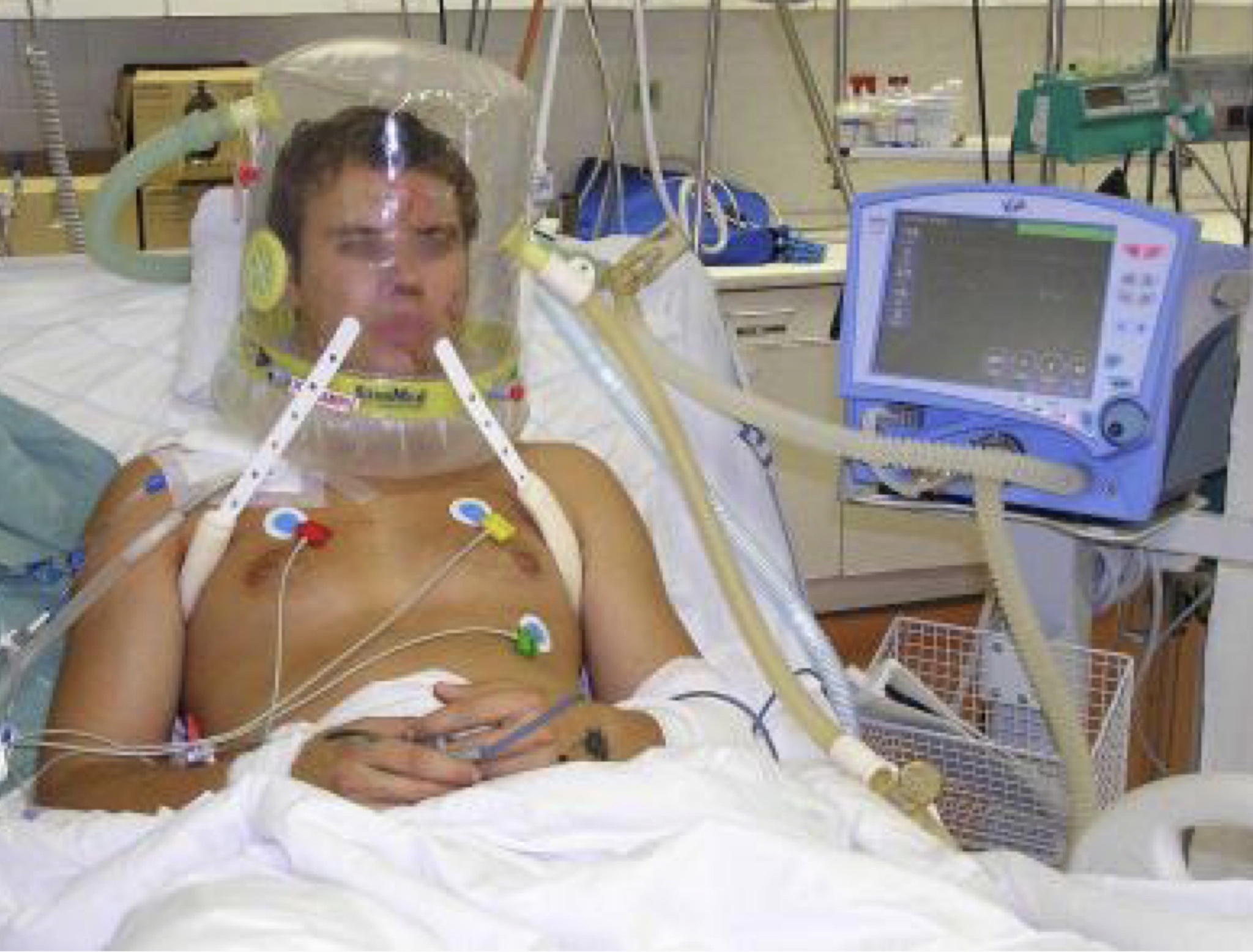 Le museruole, non sono le mascherine ma i ventilatori polmonari